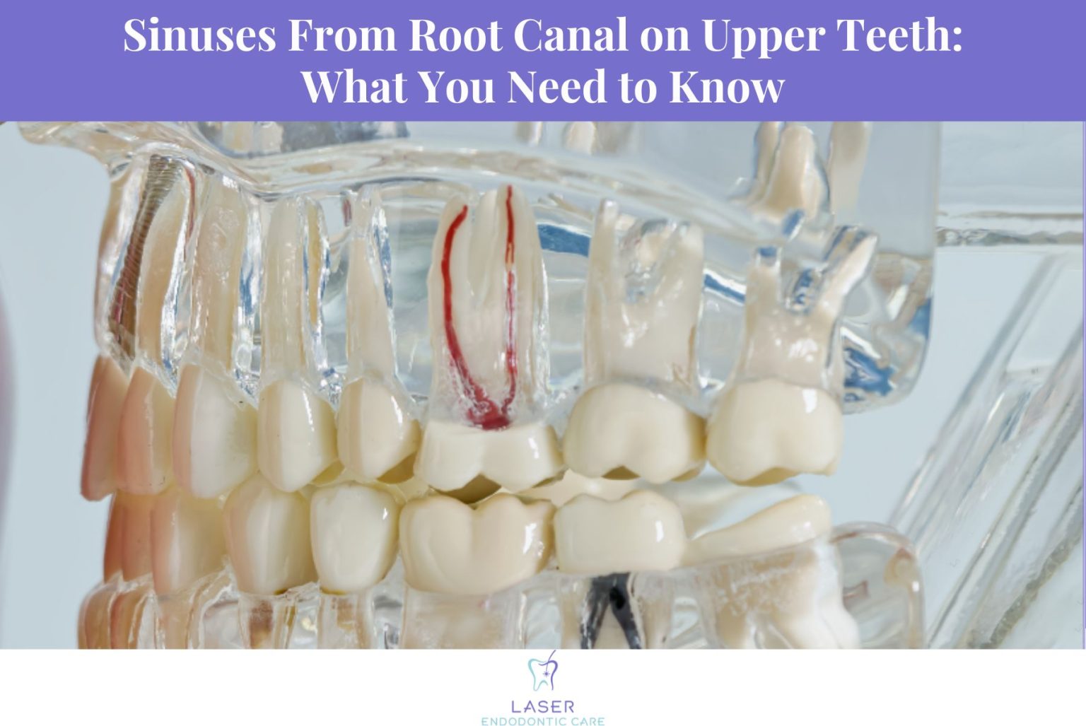 Sinuses From Root Canal on Upper Teeth: What You Need to Know | Laser ...